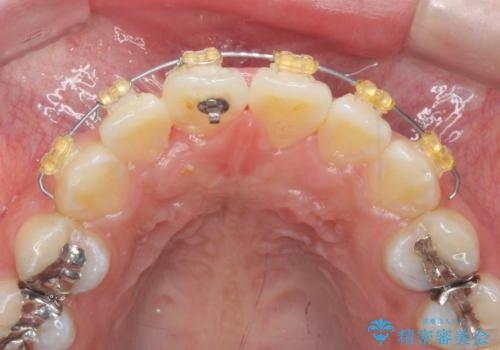 ワイヤーの小矯正を行い、治療期間を短縮するマウスピース治療の治療中