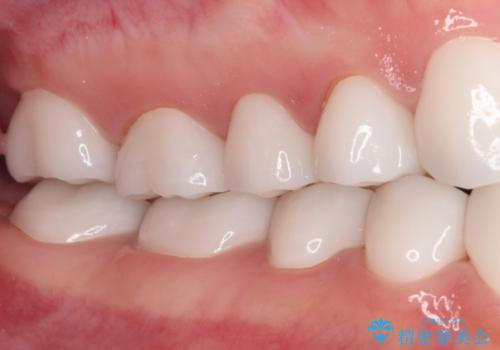 変色している歯をとにかく白く　全顎セラミック治療の治療後