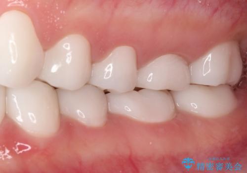 変色している歯をとにかく白く　全顎セラミック治療の治療後