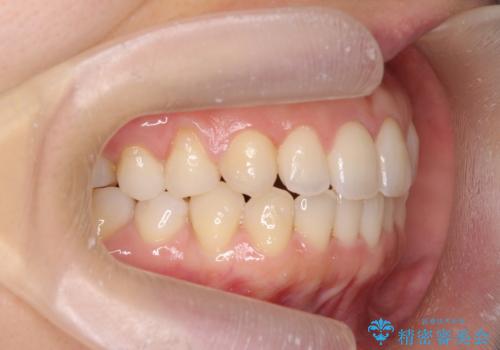[前歯のねじれ・がたつきを治したい ]ワイヤーとマウスピースの併用矯正治療の治療後
