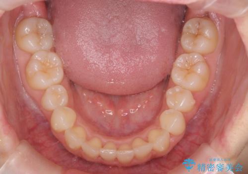 [前歯のねじれ・がたつきを治したい ]ワイヤーとマウスピースの併用矯正治療の治療中