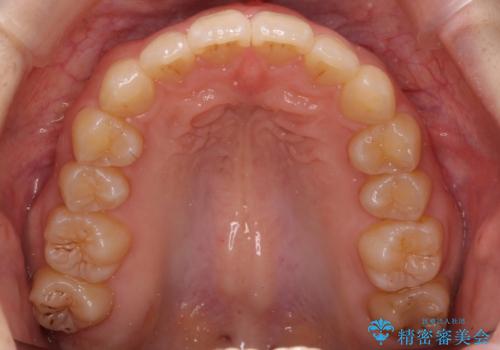 奥歯のかみ合わせも妥協しない　インビザライン治療の治療後