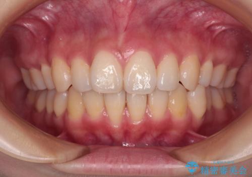 長く見えてしまう下顎前歯　歯肉移植術で露出した歯根を覆い隠すの治療前