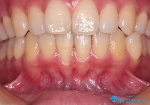 長く見えてしまう下顎前歯　歯肉移植術で露出した歯根を覆い隠すの治療前