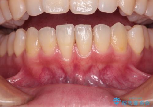 長く見えてしまう下顎前歯 歯肉移植術で露出した歯根を覆い隠すの治療前