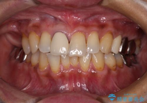 骨造成された奥歯のインプラント補綴治療の治療前