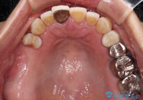 骨造成された奥歯のインプラント補綴治療の治療前
