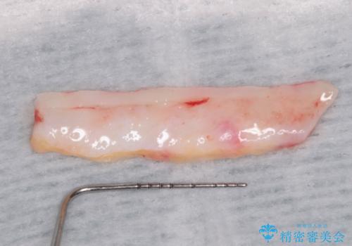 長く見えてしまう下顎前歯 歯肉移植術で露出した歯根を覆い隠すの治療前