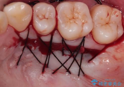 長く見えてしまう下顎前歯　歯肉移植術で露出した歯根を覆い隠すの治療中