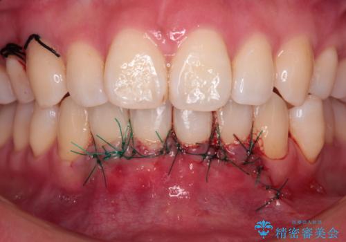 長く見えてしまう下顎前歯 歯肉移植術で露出した歯根を覆い隠すの治療中