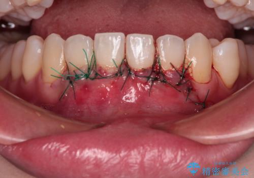 長く見えてしまう下顎前歯　歯肉移植術で露出した歯根を覆い隠すの治療中