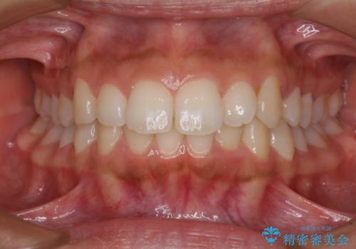 閉じにくい唇 抜歯矯正でスッキリした横顔にの治療前