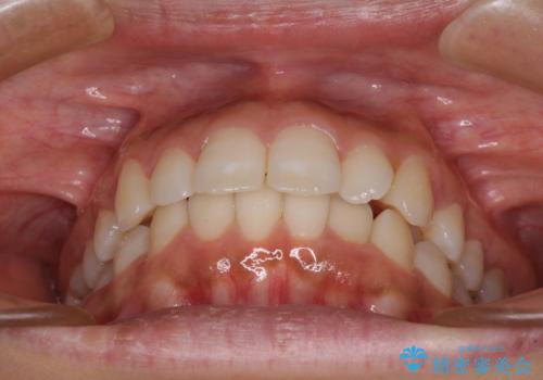 閉じにくい唇 抜歯矯正でスッキリした横顔にの治療前