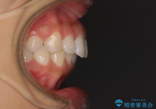 閉じにくい唇 抜歯矯正でスッキリした横顔にの治療前