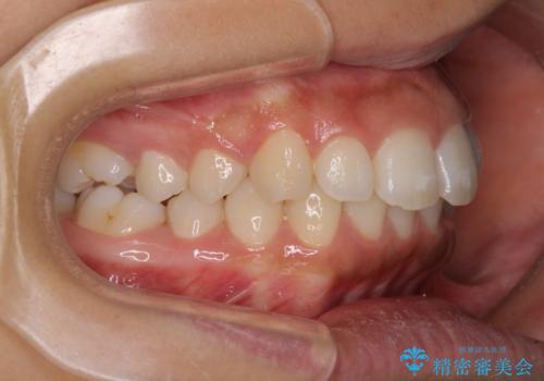 閉じにくい唇 抜歯矯正でスッキリした横顔にの治療前