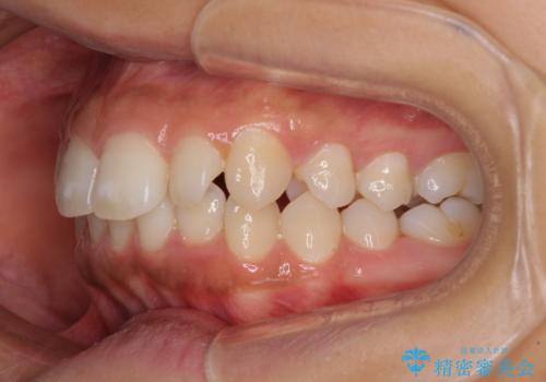 閉じにくい唇 抜歯矯正でスッキリした横顔にの治療前