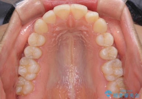 閉じにくい唇 抜歯矯正でスッキリした横顔にの治療前