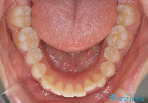 閉じにくい唇 抜歯矯正でスッキリした横顔にの治療前