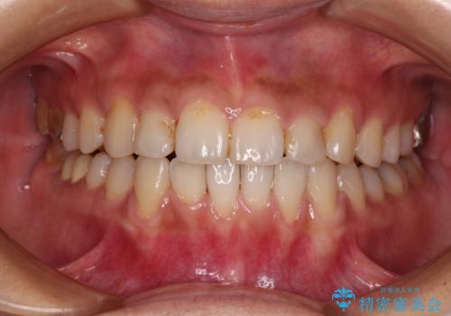 前歯のデコボコとクロスバイト インビザラインによる矯正治療の治療中