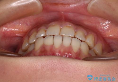 前歯のデコボコとクロスバイト インビザラインによる矯正治療の治療中
