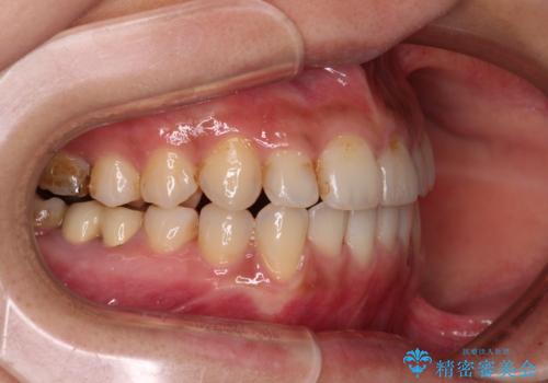 前歯のデコボコとクロスバイト インビザラインによる矯正治療の治療中