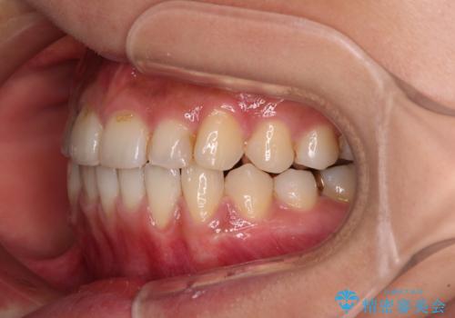 前歯のデコボコとクロスバイト インビザラインによる矯正治療の治療中