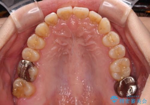 前歯のデコボコとクロスバイト インビザラインによる矯正治療の治療中