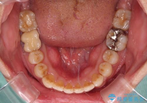 前歯のデコボコとクロスバイト　インビザラインによる矯正治療の治療中