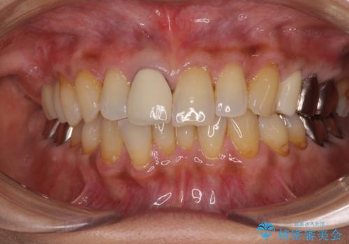骨造成された奥歯のインプラント補綴治療の治療後