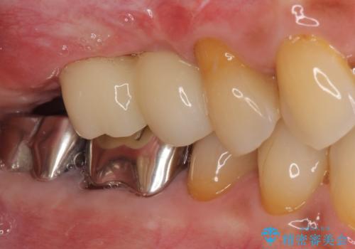 骨造成された奥歯のインプラント補綴治療の治療後