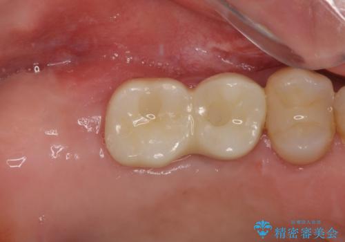 骨造成された奥歯のインプラント補綴治療