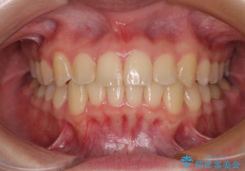 前歯のクロスバイト ギラギラのワイヤー装置で矯正治療の症例 治療後