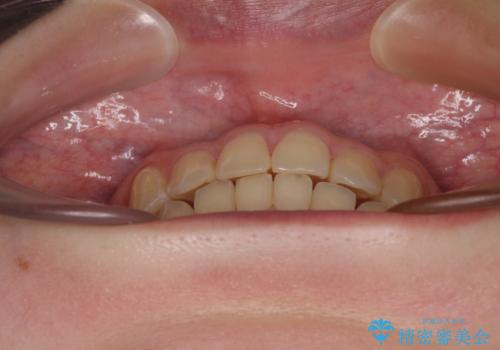 前歯のクロスバイト ギラギラのワイヤー装置で矯正治療の治療後