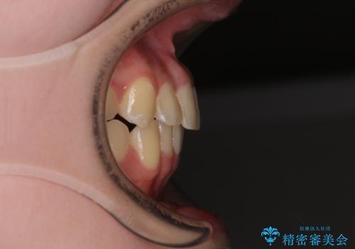 前歯のクロスバイト ギラギラのワイヤー装置で矯正治療の治療後