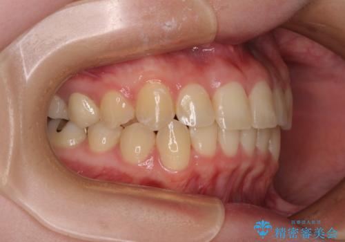 前歯のクロスバイト　ギラギラのワイヤー装置で矯正治療の治療後
