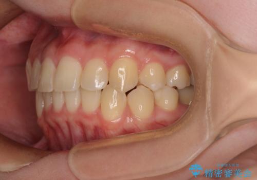 前歯のクロスバイト　ギラギラのワイヤー装置で矯正治療の治療後