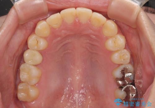 前歯のクロスバイト ギラギラのワイヤー装置で矯正治療の治療後