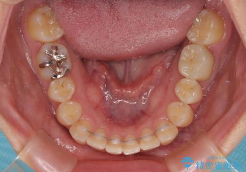 前歯のクロスバイト ギラギラのワイヤー装置で矯正治療の治療後