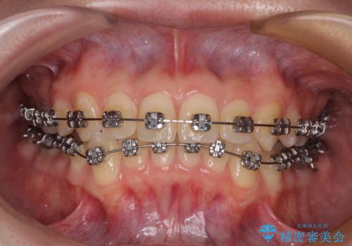 前歯のクロスバイト ギラギラのワイヤー装置で矯正治療の治療中