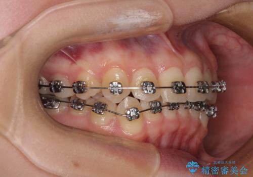 前歯のクロスバイト ギラギラのワイヤー装置で矯正治療の治療中