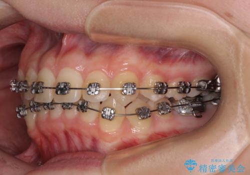 前歯のクロスバイト ギラギラのワイヤー装置で矯正治療の治療中