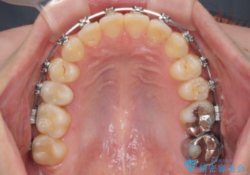 前歯のクロスバイト　ギラギラのワイヤー装置で矯正治療の治療中