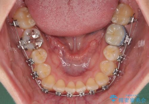 前歯のクロスバイト　ギラギラのワイヤー装置で矯正治療の治療中