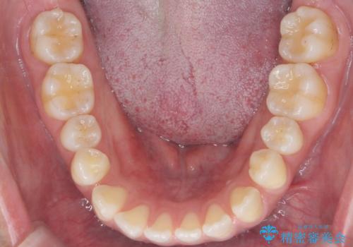 受け口、すきっ歯を　インビザラインで　モニター治療の治療前