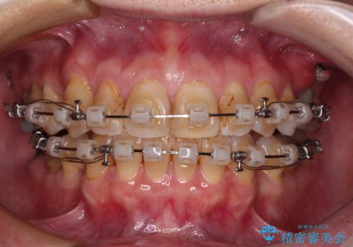 【モニター】前歯の突出感を抜歯矯正で改善の治療中