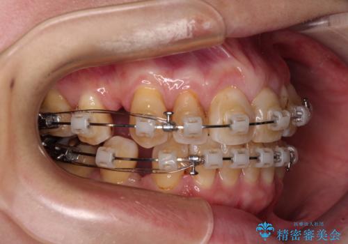 【モニター】前歯の突出感を抜歯矯正で改善の治療中