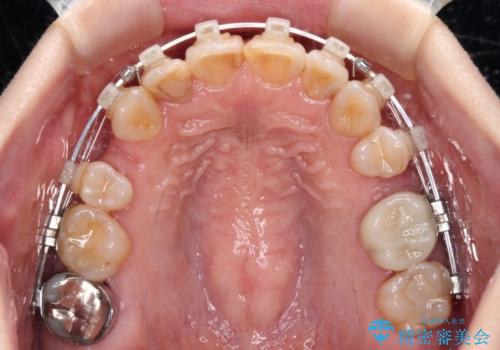 【モニター】前歯の突出感を抜歯矯正で改善の治療中