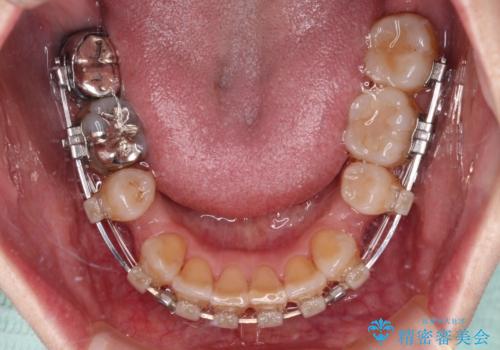 【モニター】前歯の突出感を抜歯矯正で改善の治療中