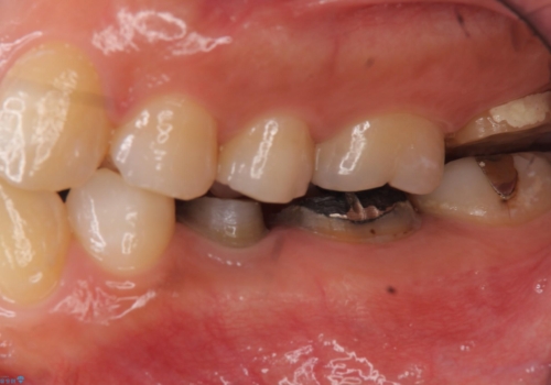 歯の高さがない 被せ物のやりなおしの治療中