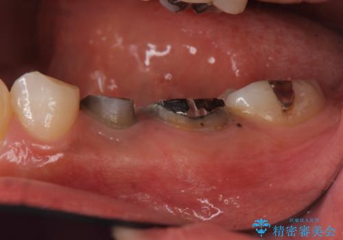 歯の高さがない 被せ物のやりなおし